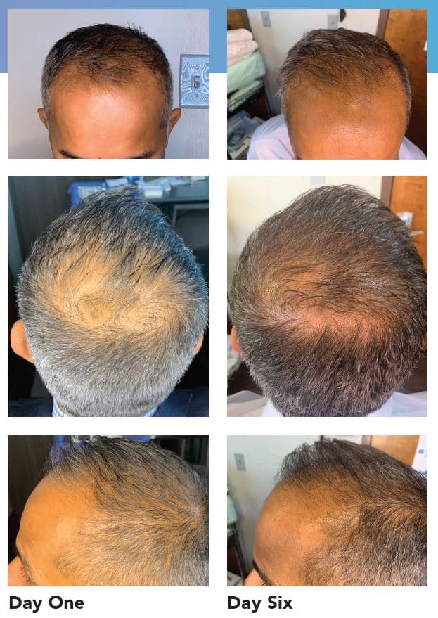 Hair regrowth results showing scalp improvement after consistent use of minoxidil 5% treatment. Know the Original Minoxidil 5% Price in Bangladesh